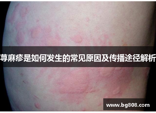 荨麻疹是如何发生的常见原因及传播途径解析
